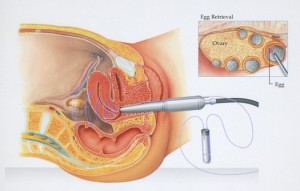 What Is Egg Donation Learn All About Donating Eggs